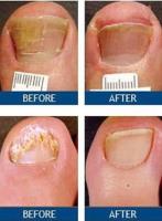 Laser Nail Therapy Houston image 3
